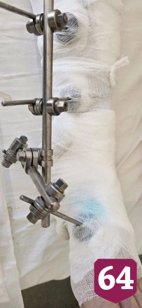  В Саратовской области культиватор раздробил пьяному мужчине ногу